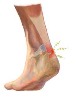 Achilles Injury Causes