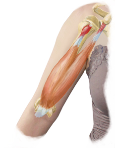 An Internal View of Bicep Tendonitis Overlaid On an Arm