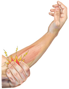 An Illustration of an Arm Suffering from Extensor Tendonitis