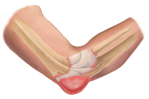 An Illustration of an Elbow Bursitis Injury