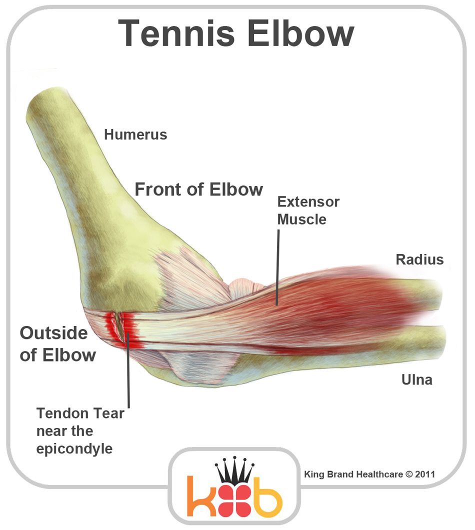 King Brand Labelled Diagram Teniis Elbow Injuries Solutions BFST Coldcure Wraps