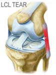 Illustration of a Torn LCL in the Knee