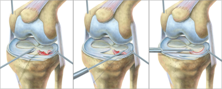 King Brand Meniscus Surgery Knee Diagram Image Meniscectomy
