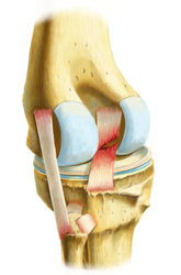 King Brand Knee Injury Diagram Image Ligament PCL
