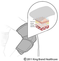 An X-Ray Illustration of the King Brand BFST® Wrap in Action