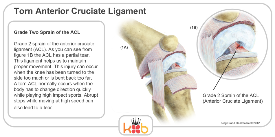 King Brand Torn Anterior Cruciate Ligament Knee Injury Diagramm Image