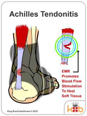 Animation of How King Brand® BFST® Wraps Treat Achilles Tendonitis with Electromagnetic Energy