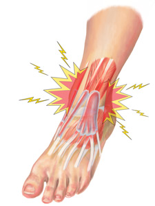 Ankle Extensor Tendonitis Treatment