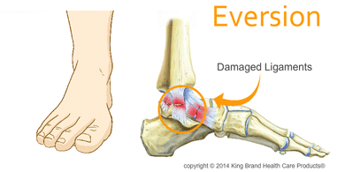 Animation of an Eversion Ankle Sprain Taking Place With an X-Ray View of the Damaged Ligaments