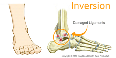 Animation of an Inversion Ankle Sprain Taking Place With an X-Ray View of the Damaged Ligaments