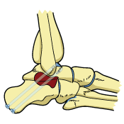 Ankle Arthrodesis Surgery Bones Joint