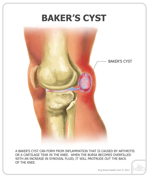 King Brand Diagram Image Baker's Cyst Information Healing Solutions