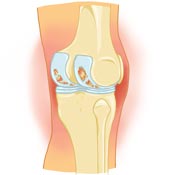 Bakers Cyst Causes