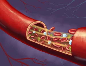 Improved bloodflow leads to better healing