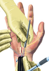 A drawing of a surgery being performed to treat a Carpal Tunnel injury