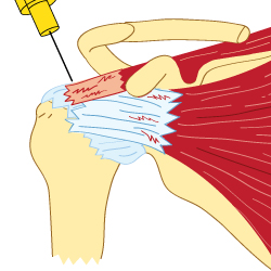 An X-Ray Illustration of a Rotator Cuff Receiving a Cortisone Treatment