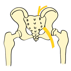 An Illustration of a Hip With Sciatica