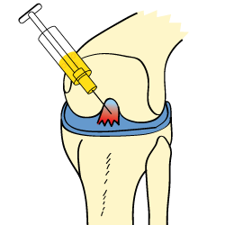King Brand Cortisone Treatment Torn ACL