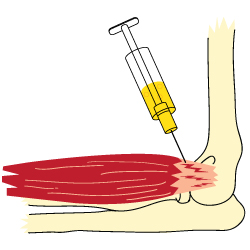 A Drawing of a Cortisone Treatment for a Tennis Elbow Injury