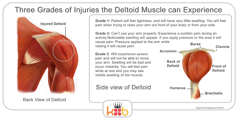 King Brand Shoulder Injury Three Grades of Injuries the Deltoid Muscle can Experience Back and Side View Labelled Diagram Information and Explanation