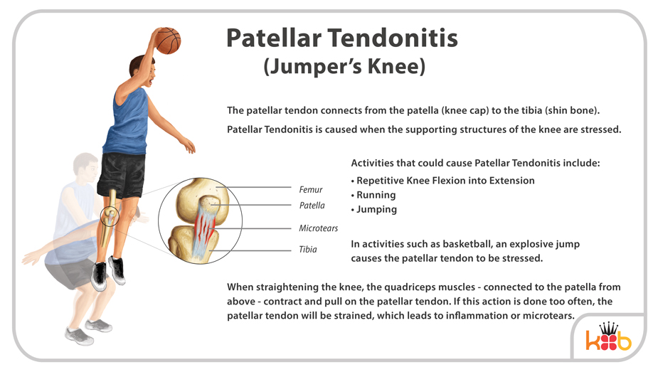 King Brand Patellar Tendonitis Treatment Explaination Diagram Image and Information