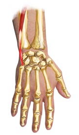 An illustration of a hand with Extensor Carpi Ulnaris Tendonitis
