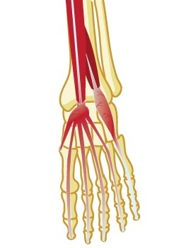 Top X-Ray View of a Foot With Extensor Tendonitis