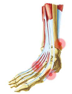 Skeletal View of a Foot With Pain Points