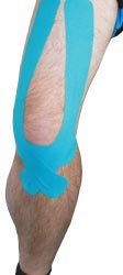 Knee Bursitis Tape Treatment