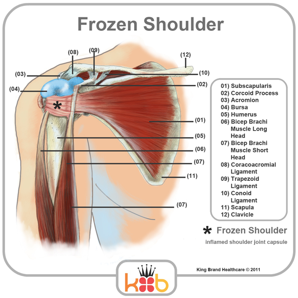King Brand Frozen Shoulder Treatment Inflamed Joints Diagram Labelled Muscles Tendons Bones Front View