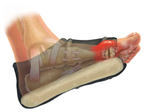 King Brand Coldcure Foot Wrap Reducing Pain and Swelling on a Gout Injury Coverage Area
