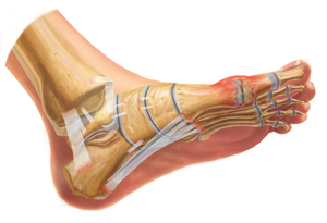 An Internal View of Gout in the Foot