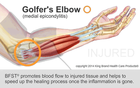 An Animation of a Golfer's Elbow Being Treated with King Brand BFST® Technology