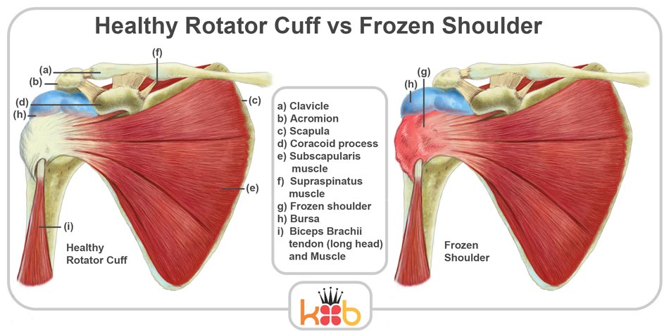 King Brand Shoulder Injury Solutions Frozen Shoulder Compared to Healthy Rotator Cuff Muscles Bones