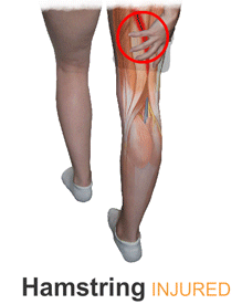 An Animation of the King Brand BFST Leg Wrap Treating an Injured Hamstring