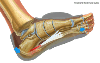 King Brand Coldcure Foot Wrap Reducing Pain and Swelling on a Heel Spur Injury
