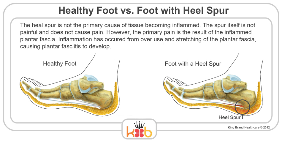 King Brand Foot Injury Heel Spur and Healthy Foot Comparision Causes Information and Illustration
