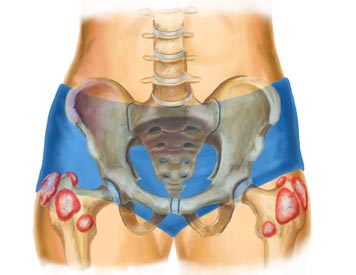 X-Ray View of a Hip Bursitis Injury