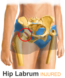 Animation of the Healing Process of a Hip Labrum Tear