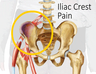 An Animation Showing How the King Brand BFST Treats Iliac Crest Pain