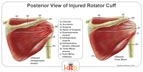 An Informational Diagram of the Back View of Injured Rotator Cuffs