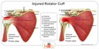 A Small Informational Diagram of a Rotator Cuff Injury