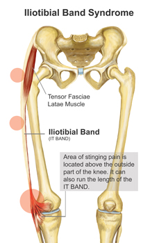 An Annotated Diagram of an Illiotibial Band Injury