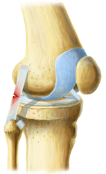 King Brand Knee Injury Diagram Image Ligament LCL