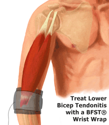 An Animation of King Brand's Wrist BFST Wrap Treating a Lower Bicep Tendonitis Injury