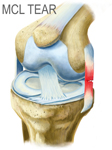 Illustration of a Torn ALC in the Knee