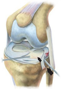 King Brand Meniscus Tear Surgery BFST Coldcure Diagram Image Knee Injury