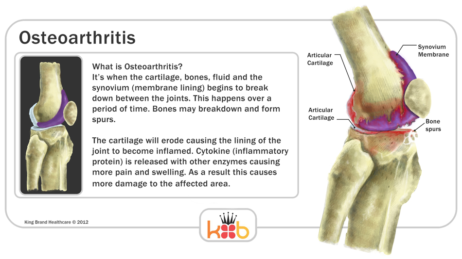 King Brand Osteoarthritis Explaination Diagram Image Information Ice Packs and Wraps Solution