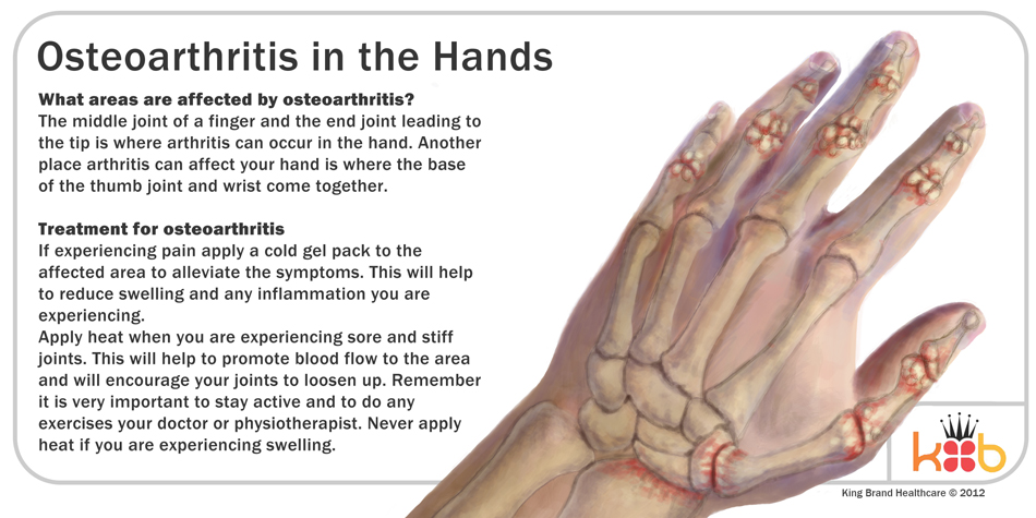 Osteoarthritis in the Hands can Be Treated by King Brand® Information Illustration