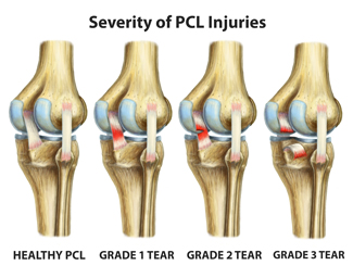 King Brand BFST Coldcure Different Grades of PCL Tears Knee Injury Diagram Image